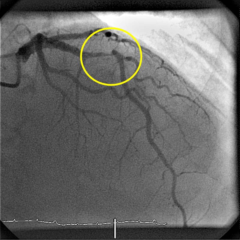 RIVA vor Stent